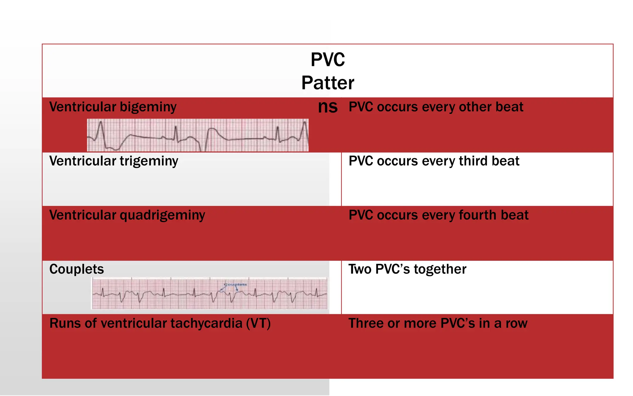 PVC
Patter
ns
Ventricular bigeminy PVC occurs every other beat
Ventricular trigeminy PVC occurs every third beat
Ventricular quadrigeminy PVC occurs every fourth beat
Couplets Two PVC’s together
Runs of ventricular tachycardia (VT) Three or more PVC’s in a row
 