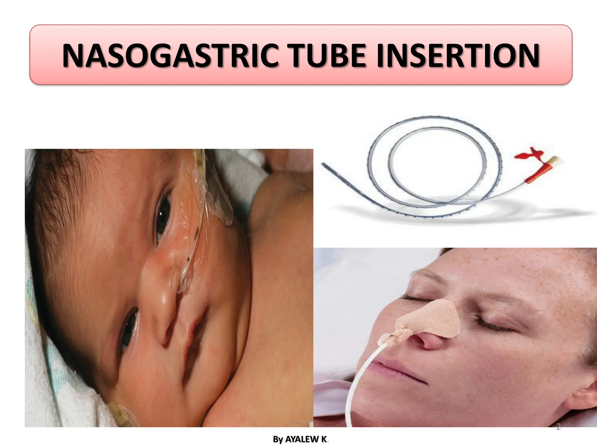 NASOGASTRIC TUBE INSERTION
By AYALEW K.
2
 
