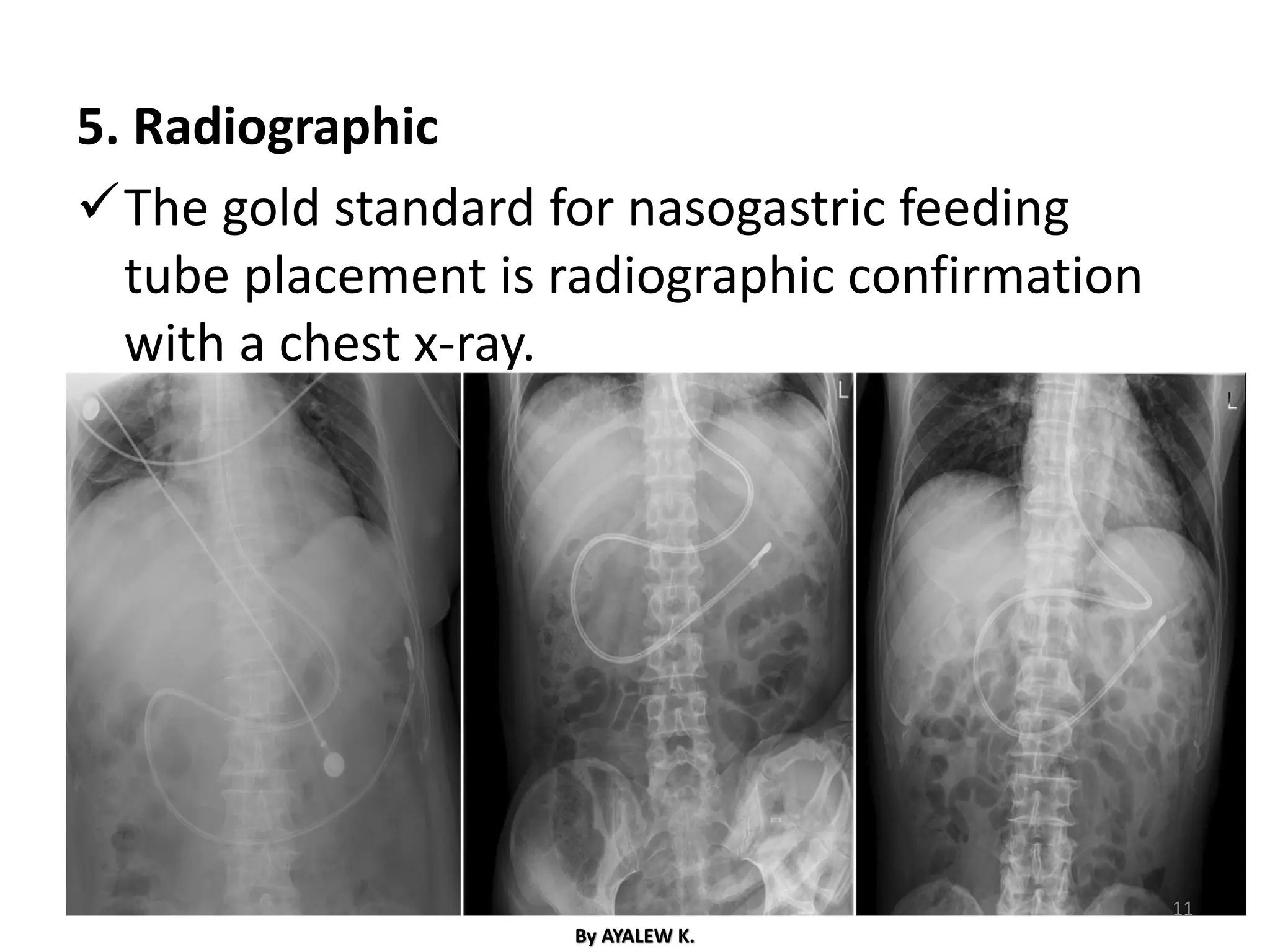 5. Radiographic
✓The gold standard for nasogastric feeding
tube placement is radiographic confirmation
with a chest x-ray.
By AYALEW K.
11
 