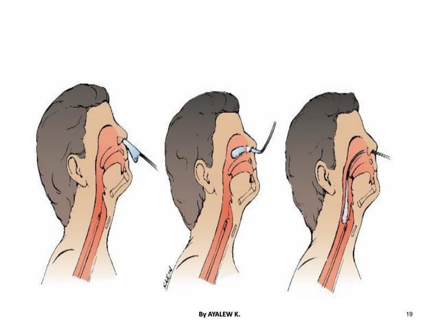 Ng Tube Injuries NASOGASTRIC TUBE INSERTION.pdf | First Aid | Injuries