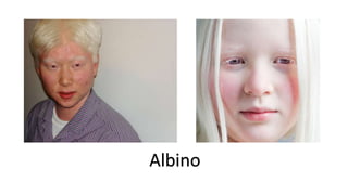 Albino
 