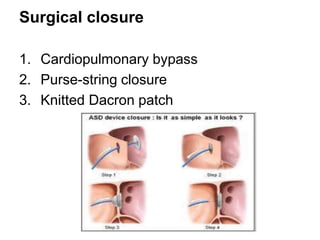 Patch Closure 2. Atrial Septal Defect - M.Rafi HAMIDI.ppt