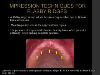 Flaring Ridge Defect 2. EVALUATION OF IMPRESSION TECHNIQUE IN COMPLETE DENTURE.pptx
