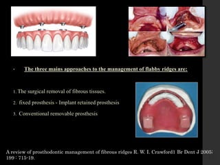 Removable Ridges 2. EVALUATION OF IMPRESSION TECHNIQUE IN COMPLETE DENTURE.pptx
