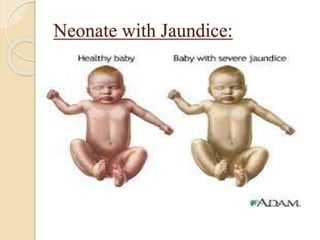 Neonate with Jaundice:
 
