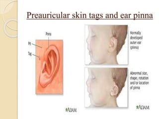 Preauricular skin tags and ear pinna
 