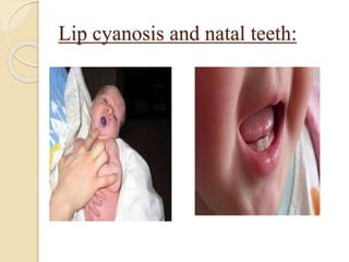 Lip cyanosis and natal teeth:
 