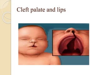 Cleft palate and lips
 