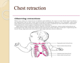 Chest retraction
 