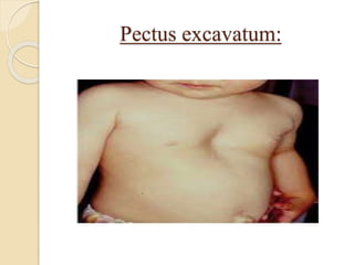 Pectus excavatum:
 