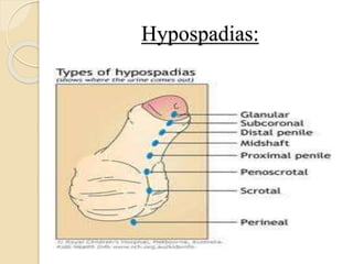 Hypospadias:
 