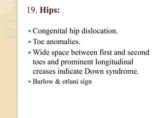 19. Hips:
 Congenital hip dislocation.
 Toe anomalies.
 Wide space between first and second
toes and prominent longitudinal
creases indicate Down syndrome.
 Barlow & otlani sign
 