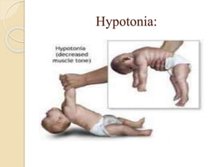 Hypotonia:
 