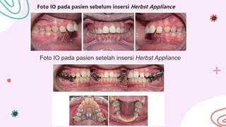 Herbst appliance in orthodontic power point | PPTX