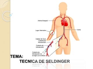 TEMA:
TECNICA DE SELDINGER
 