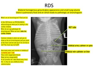 Air Bronchogram Rds 2. Respiratory problems in neonates..pdf