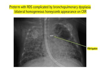 Cxr In Rds 2. Respiratory problems in neonates..pdf
