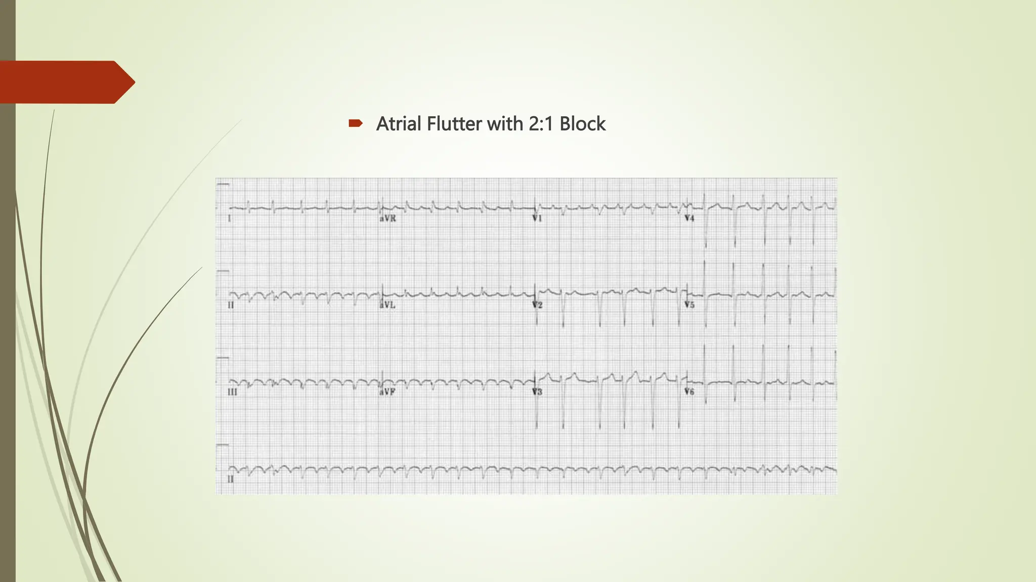  Atrial Flutter with 2:1 Block