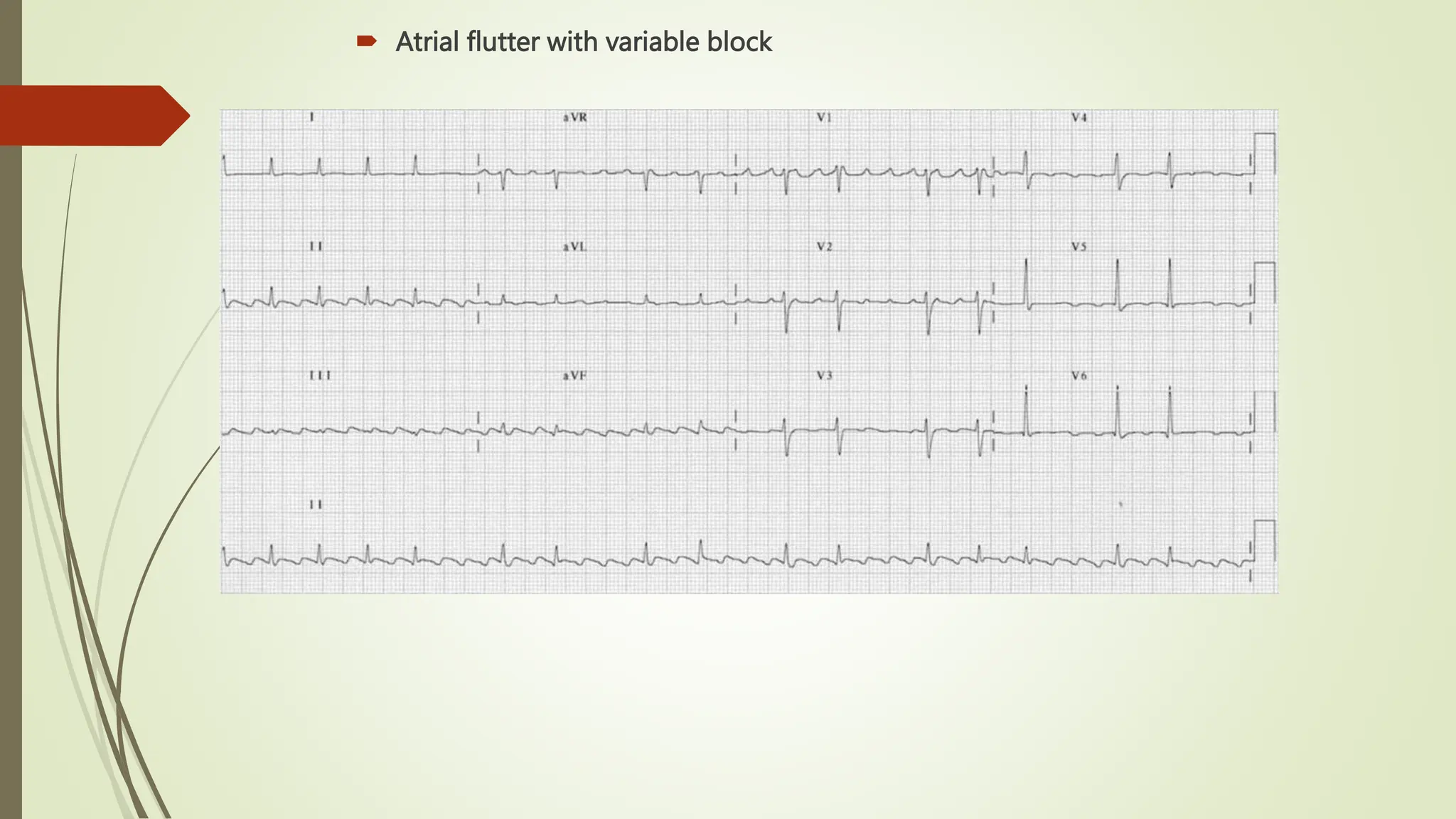  Atrial flutter with variable block