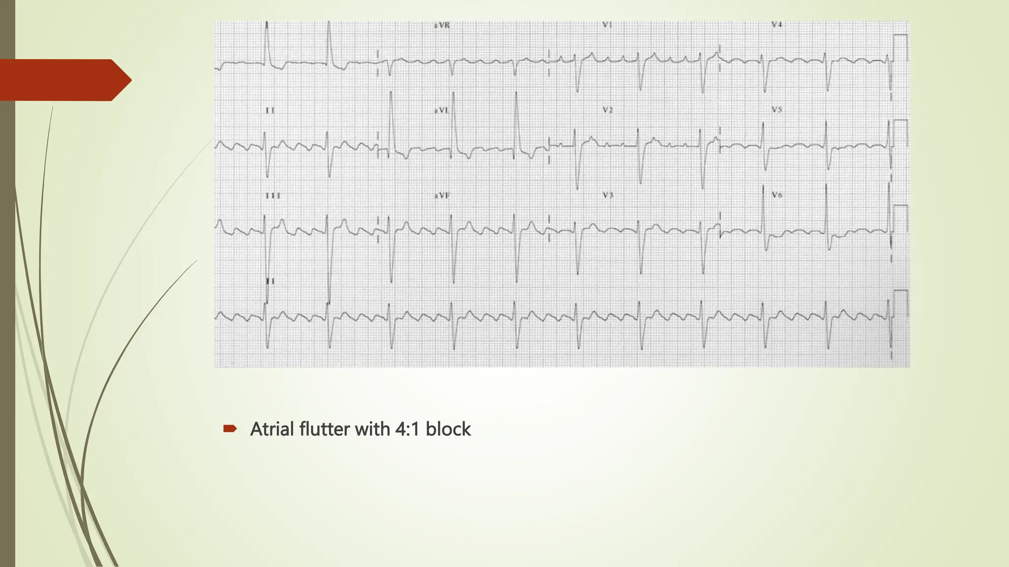  Atrial flutter with 4:1 block