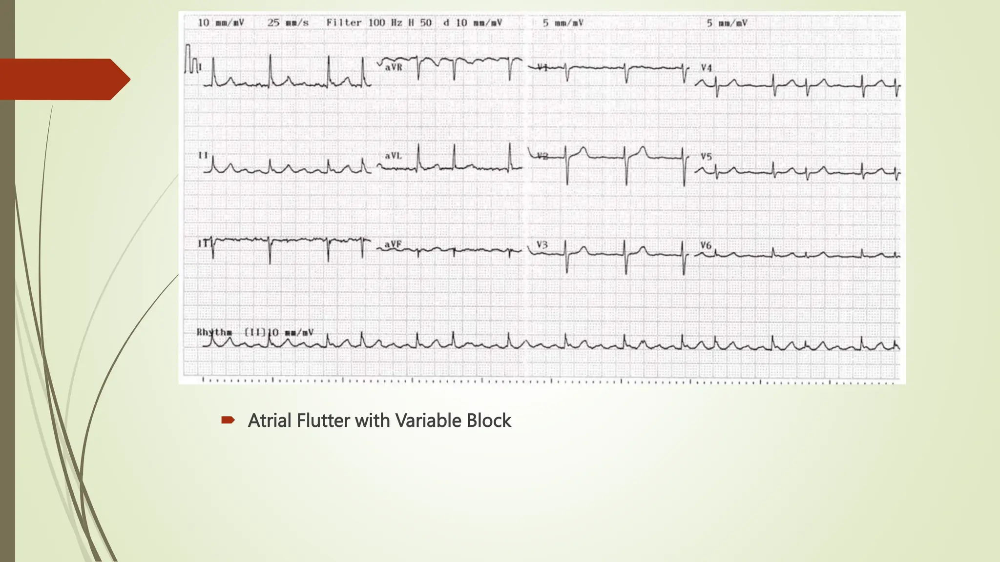  Atrial Flutter with Variable Block