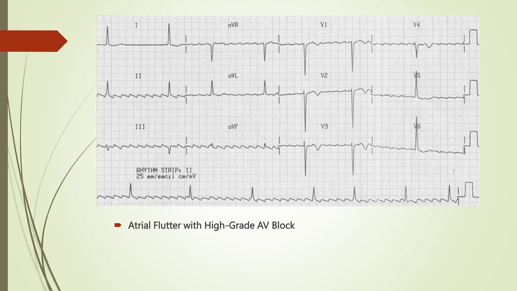  Atrial Flutter with High-Grade AV Block