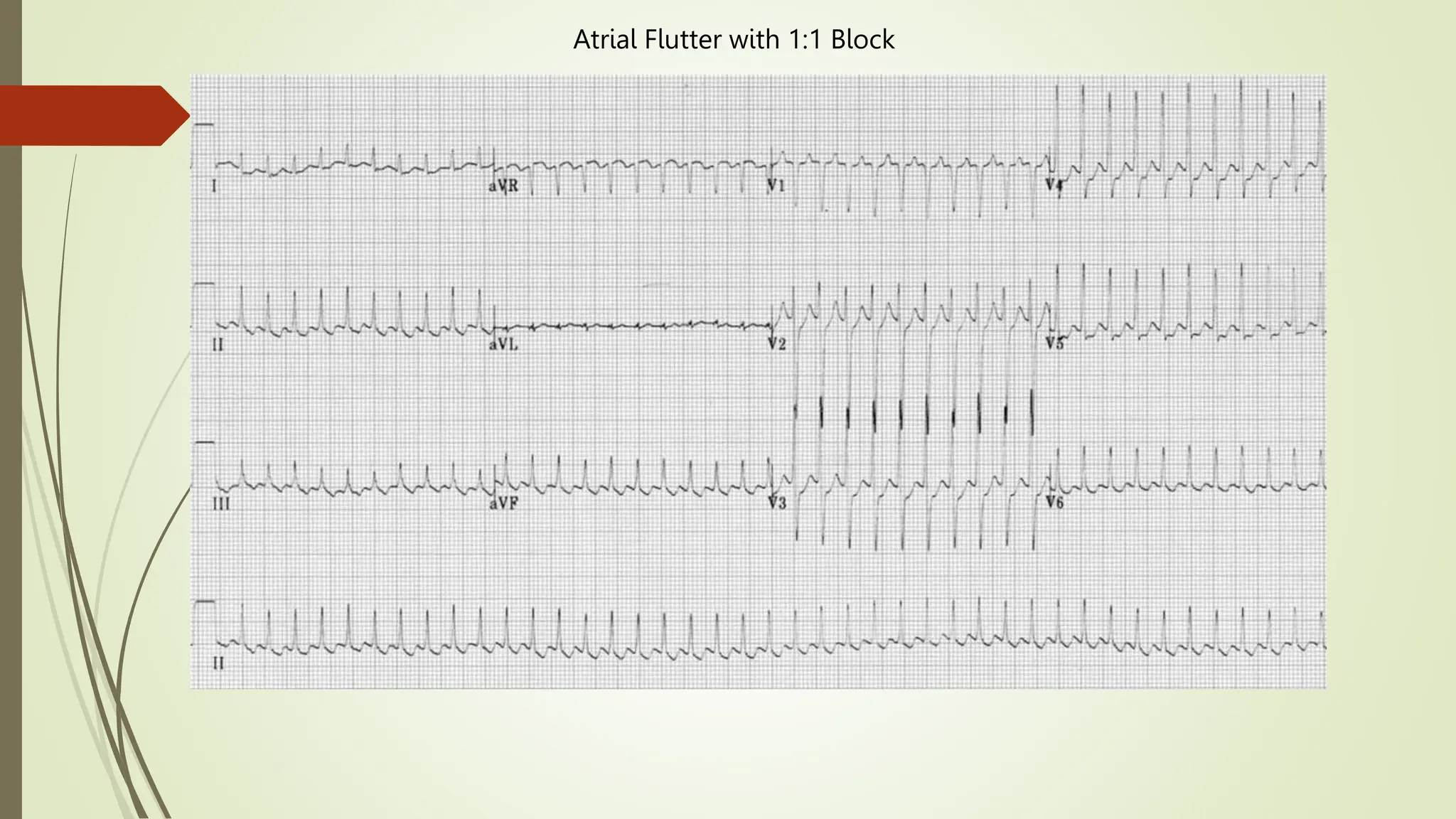 Atrial Flutter with 1:1 Block