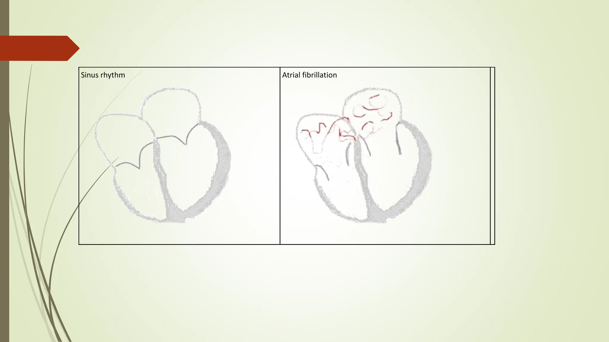 Sinus rhythm Atrial fibrillation