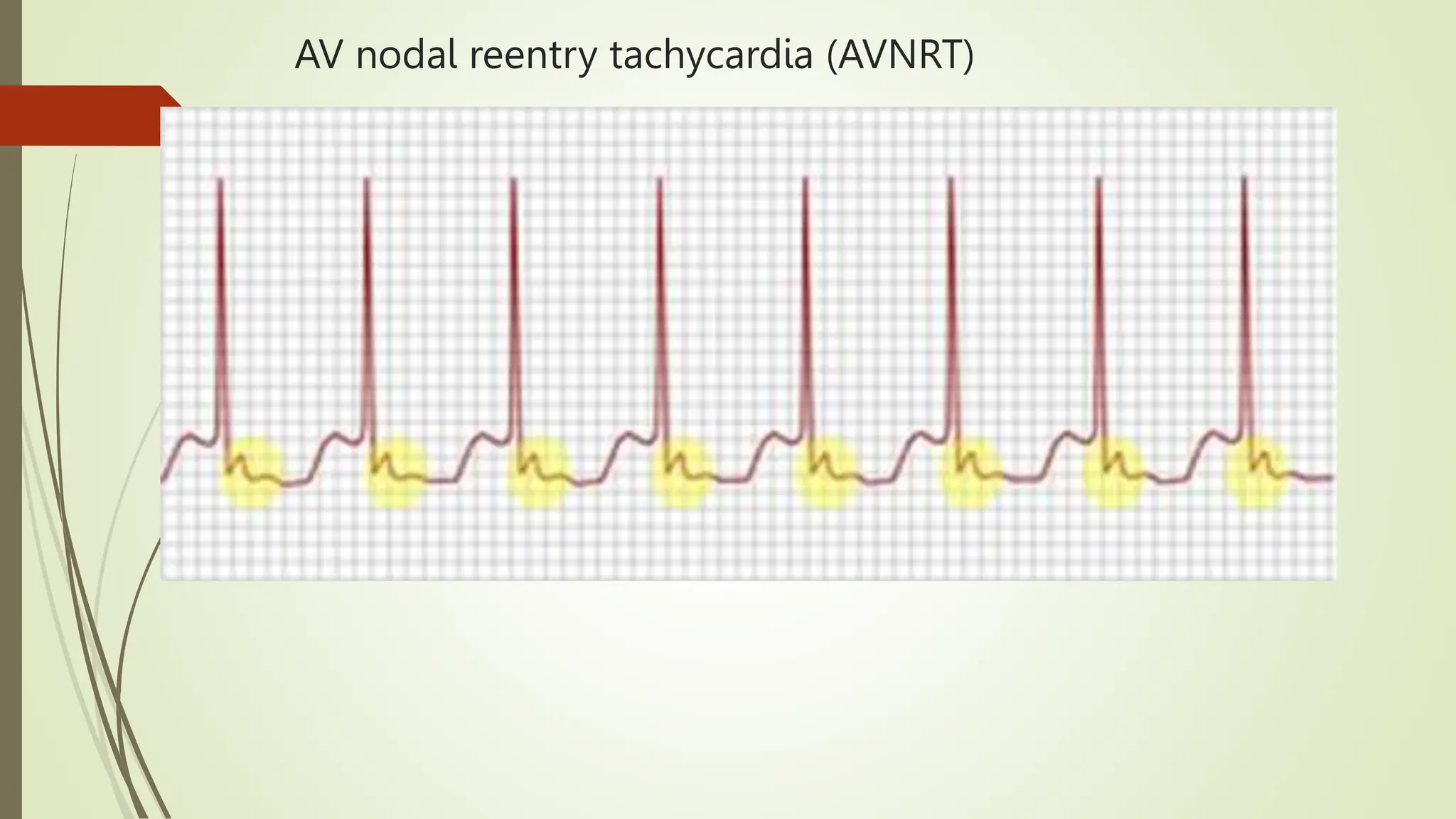 AV nodal reentry tachycardia (AVNRT)