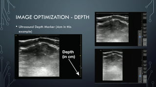 IMAGE OPTIMIZATION - DEPTH
• Ultrasound Depth Marker (4cm in this
example)
 