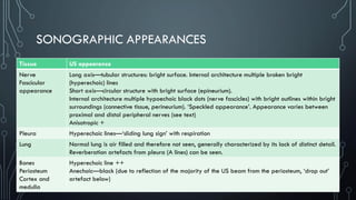 SONOGRAPHIC APPEARANCES
Tissue US appearance
Nerve
Fascicular
appearance
Long axis—tubular structures: bright surface. Internal architecture multiple broken bright
(hyperechoic) lines
Short axis—circular structure with bright surface (epineurium).
Internal architecture multiple hypoechoic black dots (nerve fascicles) with bright outlines within bright
surroundings (connective tissue, perineurium). ‘Speckled appearance’. Appearance varies between
proximal and distal peripheral nerves (see text)
Anisotropic +
Pleura Hyperechoic lines—‘sliding lung sign’ with respiration
Lung Normal lung is air filled and therefore not seen, generally characterized by its lack of distinct detail.
Reverberation artefacts from pleura (A lines) can be seen.
Bones
Periosteum
Cortex and
medulla
Hyperechoic line ++
Anechoic—black (due to reflection of the majority of the US beam from the periosteum, ‘drop out’
artefact below)
 