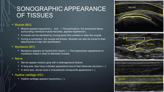 SONOGRAPHIC APPEARANCE
OF TISSUES
• Muscle (MU)
• Muscle appears hypoechoic (A and B). The perimysium, the connective tissue
surrounding individual muscle fascicles, appears hyperechoic.
• A muscle can be identified by moving joints that contract or relax the muscle.
• During a contraction, the muscle will thicken. Muscles can also be traced to their
attachments to help with identification.
• Myofascia (MY)
• Myofascia appears as hyperechoic layers (B). The hyperechoic appearance of
myofascia makes it easy to delineate muscles.
• Nerve
• Nerves appear medium gray with a heterogeneous texture.
• In long axis, they have a striated appearance due to their fascicular structure (C).
• In short axis, nerves have a characteristic honeycomb appearance (B).
• Hyaline cartilage (HC)
• Hyaline cartilage appears hypoechoic (A).
 