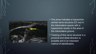 • The arrow indicates a hypoechoic
central nerve structure (C5 root in
the interscalene space) with a
hyperechoic border in the area of
the interscalene groove.
• Tracking of this nerve structure in a
proximal and distal direction is
possible and is an important
method of identification.
 