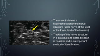 • The arrow indicates a
hyperechoic peripheral nerve
structure (ulnar nerve at the level
of the lower third of the forearm).
• Tracking of this nerve structure
in a proximal and distal direction
is possible and is an important
method of identification.
 