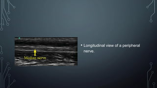 • Longitudinal view of a peripheral
nerve.
 