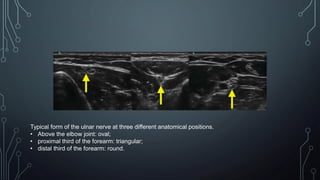 Typical form of the ulnar nerve at three different anatomical positions.
• Above the elbow joint: oval;
• proximal third of the forearm: triangular;
• distal third of the forearm: round.
 