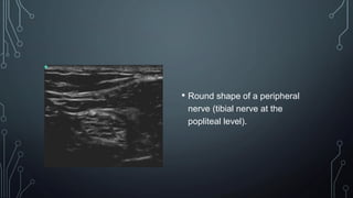 • Round shape of a peripheral
nerve (tibial nerve at the
popliteal level).
 