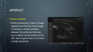 ARTEFACT
Contact artefacts
• Where shadowing or lack of image
appears from the top of the image,
it indicates a contact problem
between the probe and the skin,
e.g. a hollow curved surface of the
skin, lack of gel on skin, or at worst
a faulty transducer
 