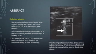 ARTEFACT
Reflection artefacts
• Some anatomical structures have a large
smooth surface and can act as ‘mirror’
reflectors of US (e.g. diaphragm, bone,
pleural).
• A 2nd or reflected image then appears in a
place on the image where anatomically it is
unlikely to be.
• For example, on colour Doppler over the
clavicular region, a 2nd image of the
subclavian artery is seen in the lungs. US showing reflection artefact. Black arrow,
subclavian artery; White arrow, reflection of
subclavian artery below pleura; Black dots,
pleura.
 