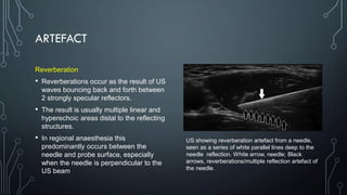 ARTEFACT
Reverberation
• Reverberations occur as the result of US
waves bouncing back and forth between
2 strongly specular reflectors.
• The result is usually multiple linear and
hyperechoic areas distal to the reflecting
structures.
• In regional anaesthesia this
predominantly occurs between the
needle and probe surface, especially
when the needle is perpendicular to the
US beam
US showing reverberation artefact from a needle,
seen as a series of white parallel lines deep to the
needle reflection. White arrow, needle; Black
arrows, reverberations/multiple reflection artefact of
the needle.
 