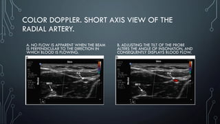 COLOR DOPPLER. SHORT AXIS VIEW OF THE
RADIAL ARTERY.
A. NO FLOW IS APPARENT WHEN THE BEAM
IS PERPENDICULAR TO THE DIRECTION IN
WHICH BLOOD IS FLOWING.
B. ADJUSTING THE TILT OF THE PROBE
ALTERS THE ANGLE OF INSONATION, AND
CONSEQUENTLY DISPLAYS BLOOD FLOW.
 