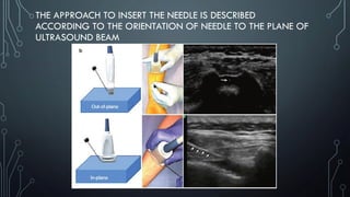 THE APPROACH TO INSERT THE NEEDLE IS DESCRIBED
ACCORDING TO THE ORIENTATION OF NEEDLE TO THE PLANE OF
ULTRASOUND BEAM
 