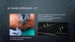 IN PLANE APPROACH - IP
IP position of the needle relative to
the ultrasound probe.
Improved visibility of the body of the needle
during a flat (left side) vs
a steep (right side) angle when the IP
technique is performed.
 