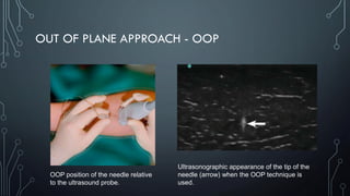 OUT OF PLANE APPROACH - OOP
OOP position of the needle relative
to the ultrasound probe.
Ultrasonographic appearance of the tip of the
needle (arrow) when the OOP technique is
used.
 