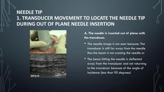 NEEDLE TIP
1. TRANSDUCER MOVEMENT TO LOCATE THE NEEDLE TIP
DURING OUT OF PLANE NEEDLE INSERTION
A. The needle is inserted out of plane with
the transducer.
• The needle image is not seen because: The
transducer is still far away from the needle
thus the beam is not crossing the needle or
• The beam hitting the needle is deflected
away from the transducer and not returning
to the transducer because of the angle of
incidence (less than 90 degrees)
 