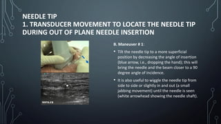 NEEDLE TIP
1. TRANSDUCER MOVEMENT TO LOCATE THE NEEDLE TIP
DURING OUT OF PLANE NEEDLE INSERTION
B. Maneuver # 1:
• Tilt the needle tip to a more superficial
position by decreasing the angle of insertion
(blue arrow, i.e., dropping the hand); this will
bring the needle and the beam closer to a 90
degree angle of incidence.
• It is also useful to wiggle the needle tip from
side to side or slightly in and out (a small
jabbing movement) until the needle is seen
(white arrowhead showing the needle shaft).
 