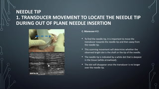 NEEDLE TIP
1. TRANSDUCER MOVEMENT TO LOCATE THE NEEDLE TIP
DURING OUT OF PLANE NEEDLE INSERTION
C. Maneuver # 2:
• To find the needle tip, it is important to move the
transducer towards the needle tip and then away from
the needle tip.
• This scanning movement will determine whether the
observed bright dot is the shaft or the tip of the needle.
• The needle tip is indicated by a white dot that is deepest
in the tissue (white arrowhead).
• The dot will disappear once the transducer is no longer
over the needle tip.
 
