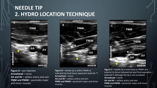 NEEDLE TIP
2. HYDRO LOCATION TECHNIQUE
Figure A = pre-injection
Arrowhead = nerve
AA and AV = axillary artery and vein
PMM and PMiM = pectoralis major
and minor muscles
Figure B = needle tip is within PMiM as
indicated by local tissue expansion (asterisk *)
Arrowhead = nerve
AA and AV = axillary artery and vein
PMM and PMiM = pectoralis major and minor
muscles
Figure C = needle tip is now deep to PMiM and
anterior to AA as indicated by local fluid expansion
(asterisk*) although the tip is not visualized
Arrowhead = nerve
AA and AV = axillary artery and vein
PMM and PMiM = pectoralis major and minor
muscles
 