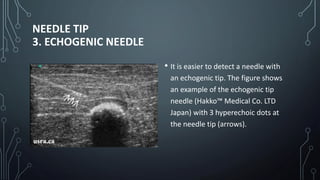 NEEDLE TIP
3. ECHOGENIC NEEDLE
• It is easier to detect a needle with
an echogenic tip. The figure shows
an example of the echogenic tip
needle (Hakko™ Medical Co. LTD
Japan) with 3 hyperechoic dots at
the needle tip (arrows).
 