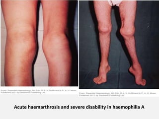 Acute haemarthrosis and severe disability in haemophilia A
 